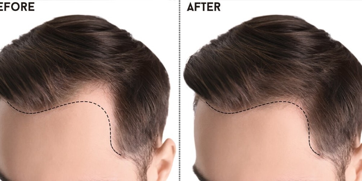 Unlocking Confidence: A Comprehensive Guide to Hair Transplants in Pakistan