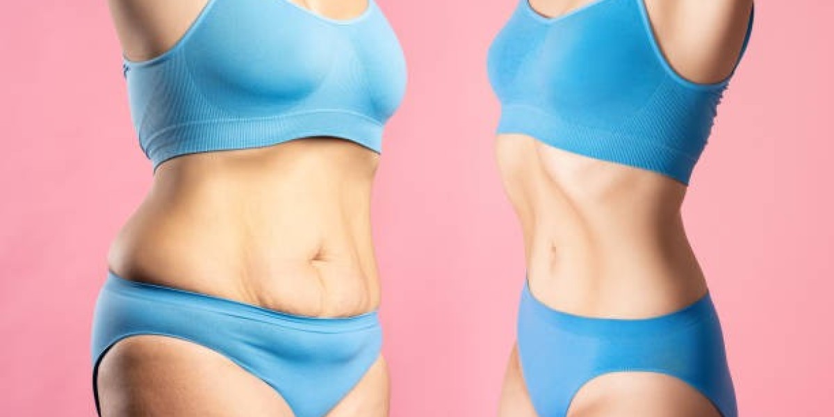 Real Talk on Liposuction Risks: What Every Patient Must Know Now